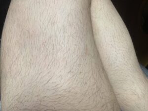 【悲報】全身脱毛5回終わったワイの足wwwwwwwwww