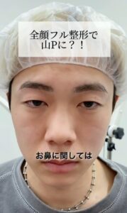 【朗報】二重整形して人生変わった奴集合wwwwwww