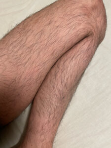 【朗報】医療脱毛２回目行ってきたでwwwwwwwww