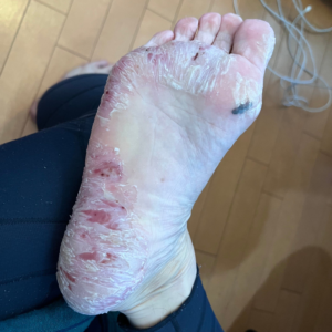【画像あり】助けて!糖尿病なんだがアトピー性皮膚炎で足が凄いことになってる!!!